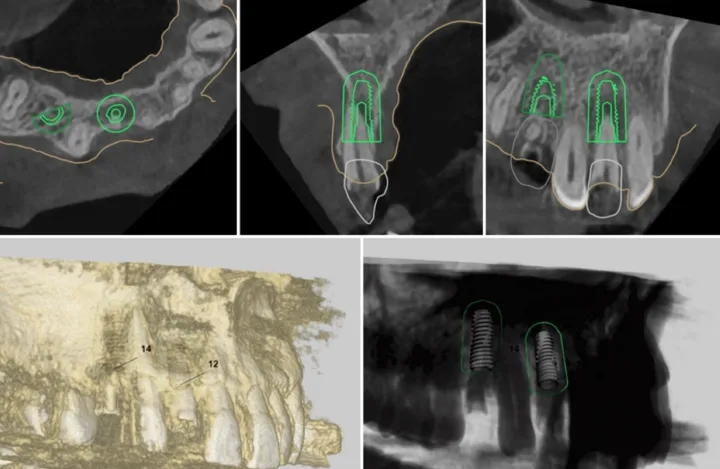 네비게이션 임플란트 3D CT 디지털 계획 화면 — 앞니 임플란트 위치·각도·깊이 사전 설계