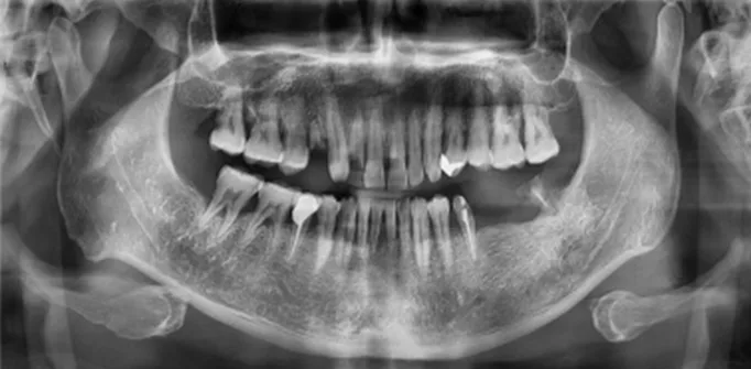 안산 앞니 임플란트 치료 전 파노라마 X-ray 검사 — 남은 자연치아와 잇몸뼈 상태 확인