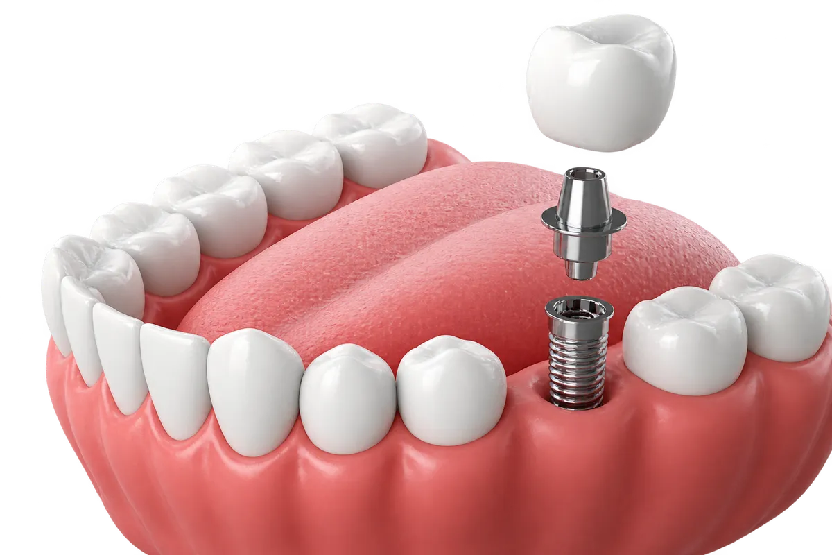 임플란트